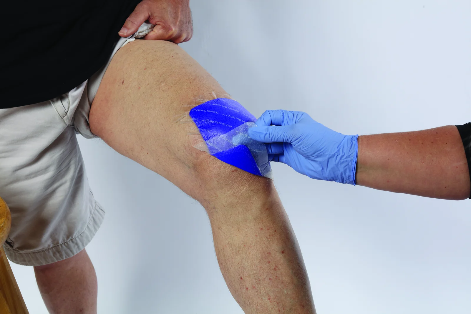 Clinician applying Hydrofera Blue READY-Border dressing to a patient knee