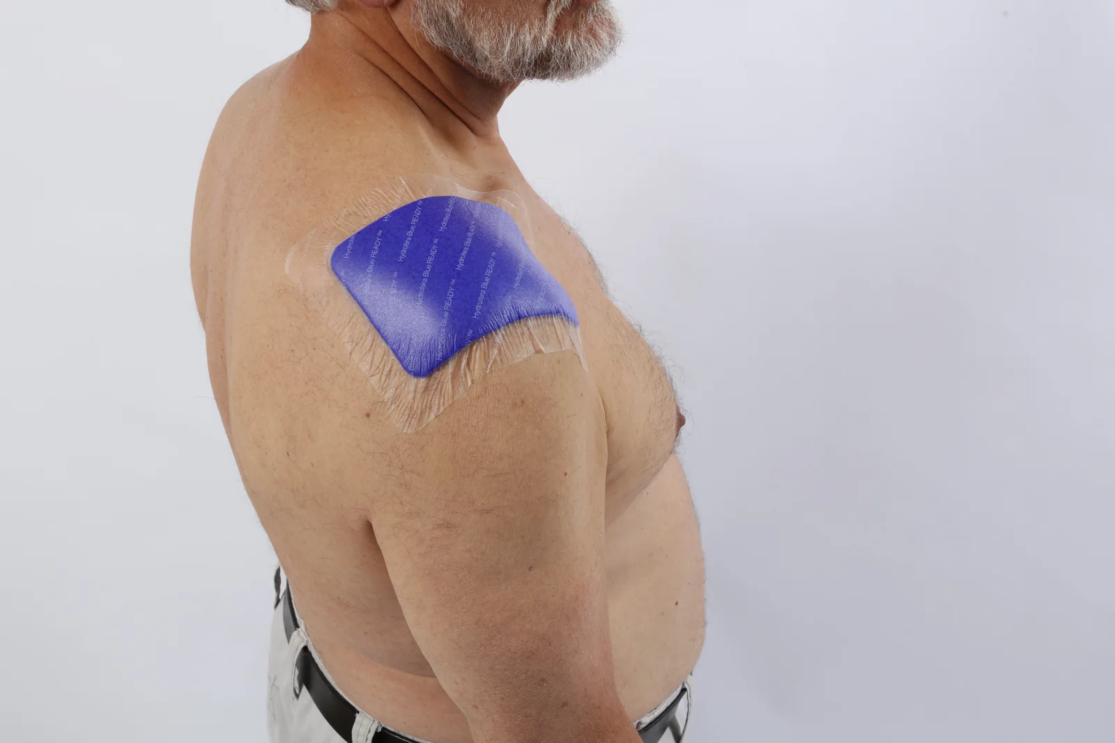 Hydrofera Blue READY-Border dressing applied at the shoulder