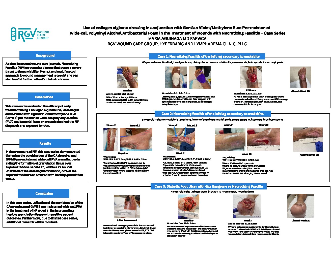 Cover preview for Use of a Collagen Dressing in Conjunction with Gentian Violet/Methylene Blue Pre-Moistened Wide-Cell Polyvinyl Alcohol Antibacterial Foam in the Treatment of Wounds with Necrotizing Fasciitis – Case Series