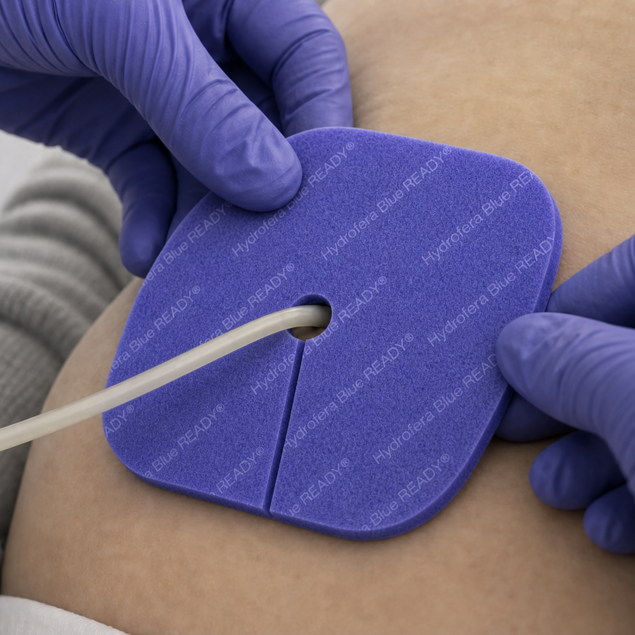 Clinician applying Hydrofera Blue READY Tube Site Dressing around a tube site